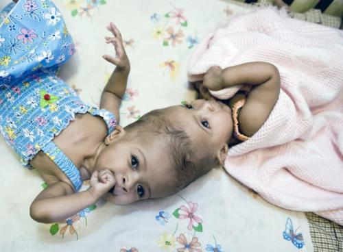 15 самых жутких реальных историй о близнецах