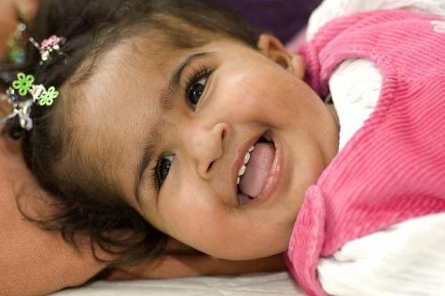 Врачи разделили мозг сиамских близнецов