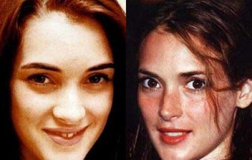 Самые лучшие исправленные носы: эволюция звездных лиц