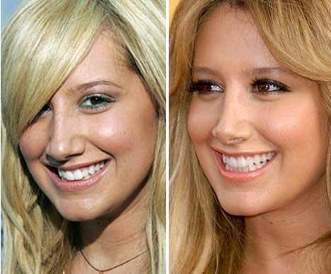 Самые лучшие исправленные носы: эволюция звездных лиц