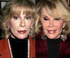 Знаменитости до и после пластической операции: почувствуйте разницу