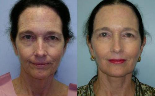 13 самых сумасшедших способов, используемых женщинами, чтобы сохранить молодость