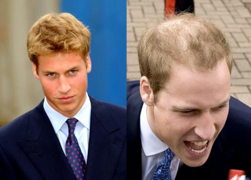 Плешивые знаменитости, которые безуспешно пытаются скрыть лысину