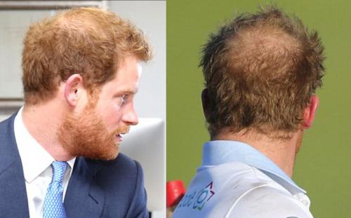 Плешивые знаменитости, которые безуспешно пытаются скрыть лысину