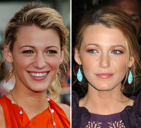 Переделанные носы знаменитостей: до и после