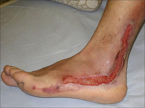 Мужчина выжил после страшного удара молнии в голову