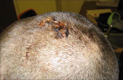 Мужчина выжил после страшного удара молнии в голову