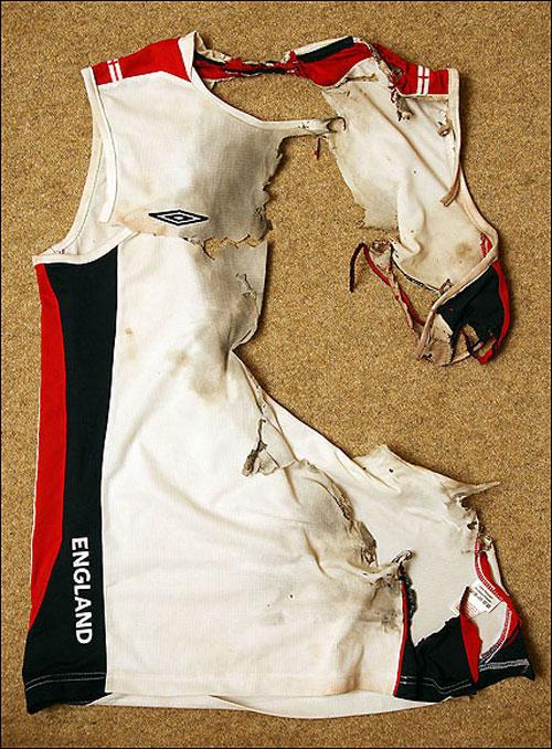 Мужчина выжил после страшного удара молнии в голову