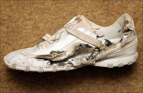 Мужчина выжил после страшного удара молнии в голову