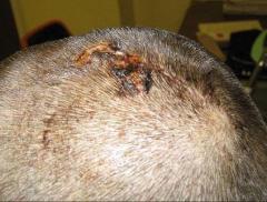 Мужчина выжил после страшного удара молнии в голову