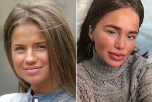 Звезды, ставшие неузнаваемыми после пластических операций