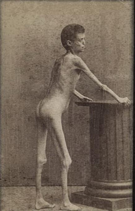 Люди в клетке: самые знаменитые персонажи цирка уродцев