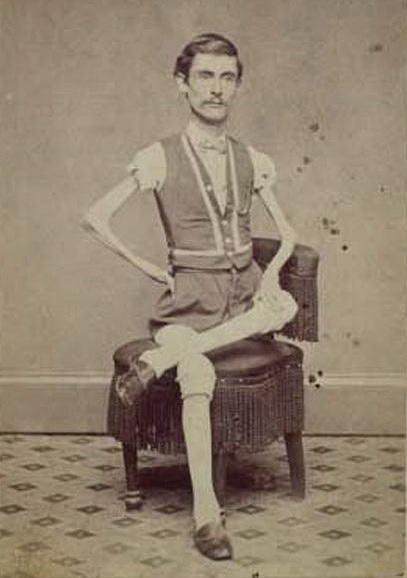 Люди в клетке: самые знаменитые персонажи цирка уродцев