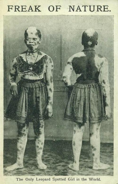 Люди в клетке: самые знаменитые персонажи цирка уродцев