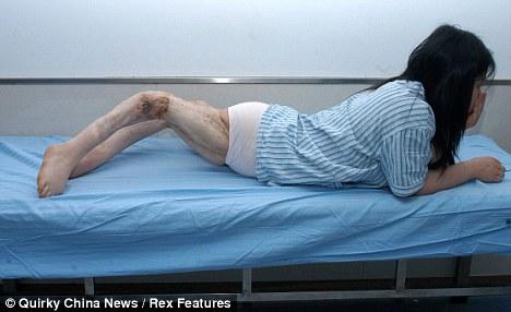 Девушке-кузнечику выправили ноги «коленками назад»