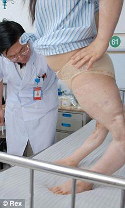 Девушке-кузнечику выправили ноги «коленками назад»