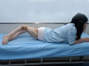 Девушке-кузнечику выправили ноги «коленками назад»