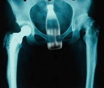 Самые невероятные рентгеновские снимки в истории медицины