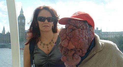 Врачи спасают вьетнамку и португальца от гигантской опухоли