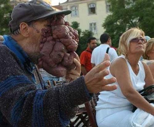 Врачи спасают вьетнамку и португальца от гигантской опухоли