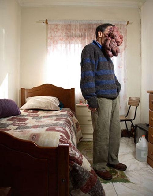 Врачи спасают вьетнамку и португальца от гигантской опухоли