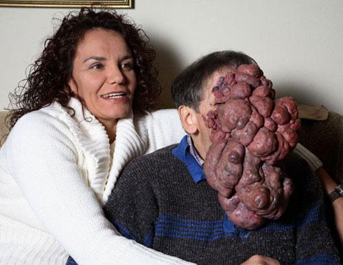 Врачи спасают вьетнамку и португальца от гигантской опухоли