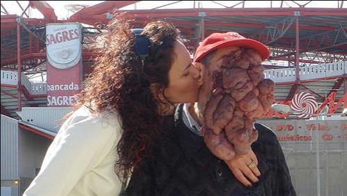 Врачи спасают вьетнамку и португальца от гигантской опухоли