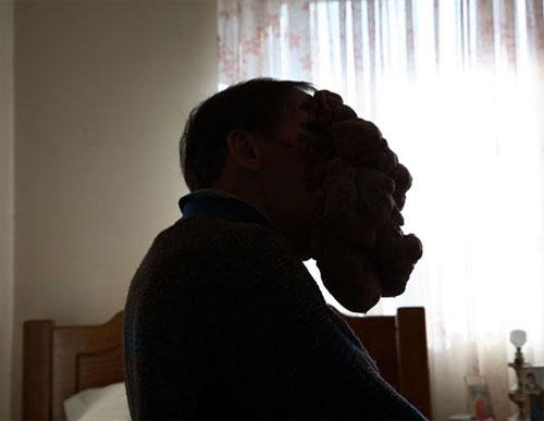 Врачи спасают вьетнамку и португальца от гигантской опухоли