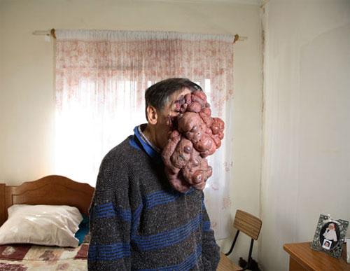 Врачи спасают вьетнамку и португальца от гигантской опухоли