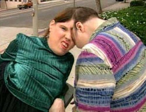 Старейшая пара сиамских близнецов, сросшихся головой, отметила 47-й день рождения