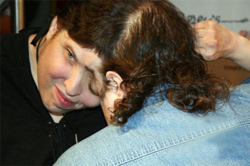 Старейшая пара сиамских близнецов, сросшихся головой, отметила 47-й день рождения