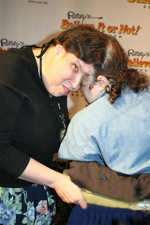 Старейшая пара сиамских близнецов, сросшихся головой, отметила 47-й день рождения