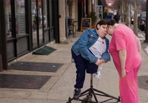 Старейшая пара сиамских близнецов, сросшихся головой, отметила 47-й день рождения