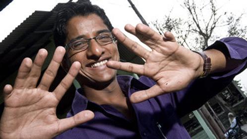 У индийца выросли 26 пальцев