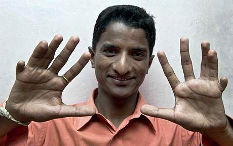У индийца выросли 26 пальцев