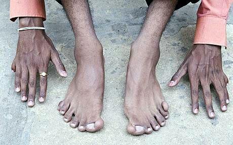 У индийца выросли 26 пальцев