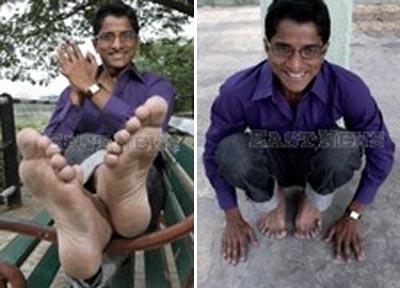 У индийца выросли 26 пальцев