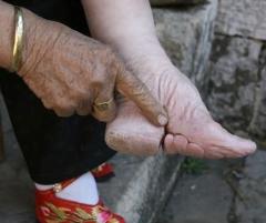 Китайской традиции деформации ступней — 1000 лет