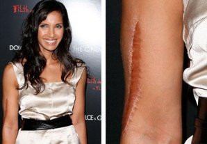 Дефекты, которые уродуют голливудских звезд