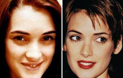 Топ-15 звезд с исправленным носом