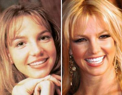 Топ-15 звезд с исправленным носом