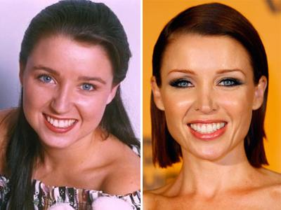 Топ-15 звезд с исправленным носом