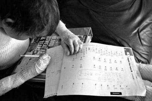 Американский мальчик живёт без кожи