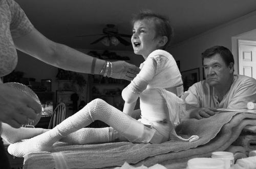 Американский мальчик живёт без кожи