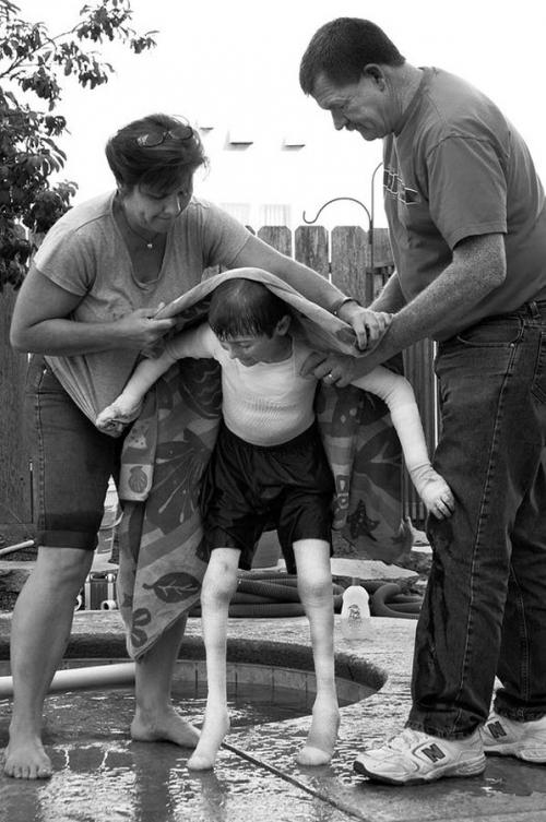 Американский мальчик живёт без кожи