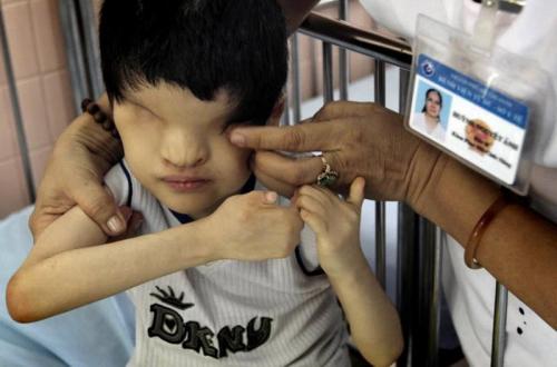 Страшные последствия химоружия во Вьетнаме