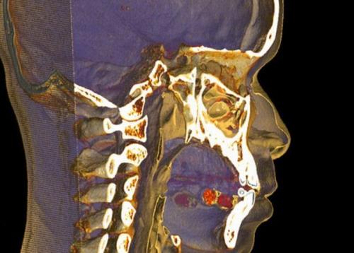 Как перевозят наркотики внутри человека