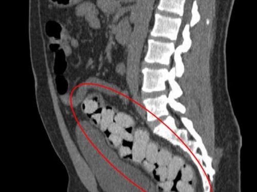 Как перевозят наркотики внутри человека
