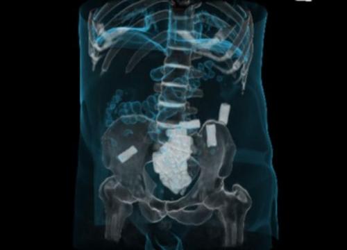 Как перевозят наркотики внутри человека