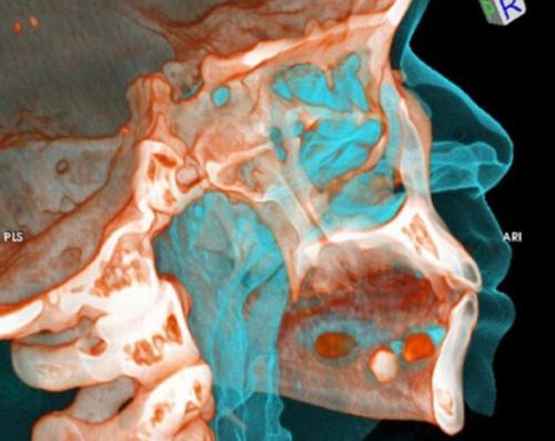 Как перевозят наркотики внутри человека